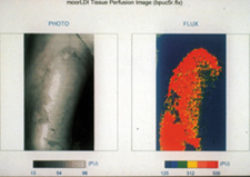 Laser doppler imaging